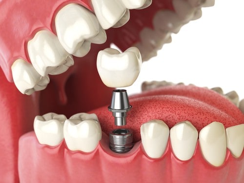 Dental Implant Demo by Illustration