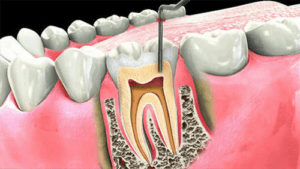 What are Some of the Signs of Needing a Root Canal?