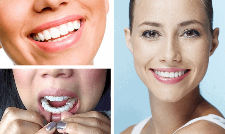Invisalign and Braces by Orthodontist