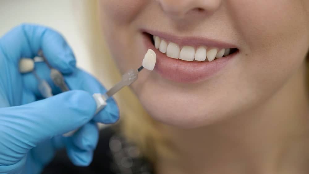 Dental Veneer Treatment at Ashfield