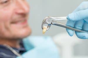 Tooth extraction treatment