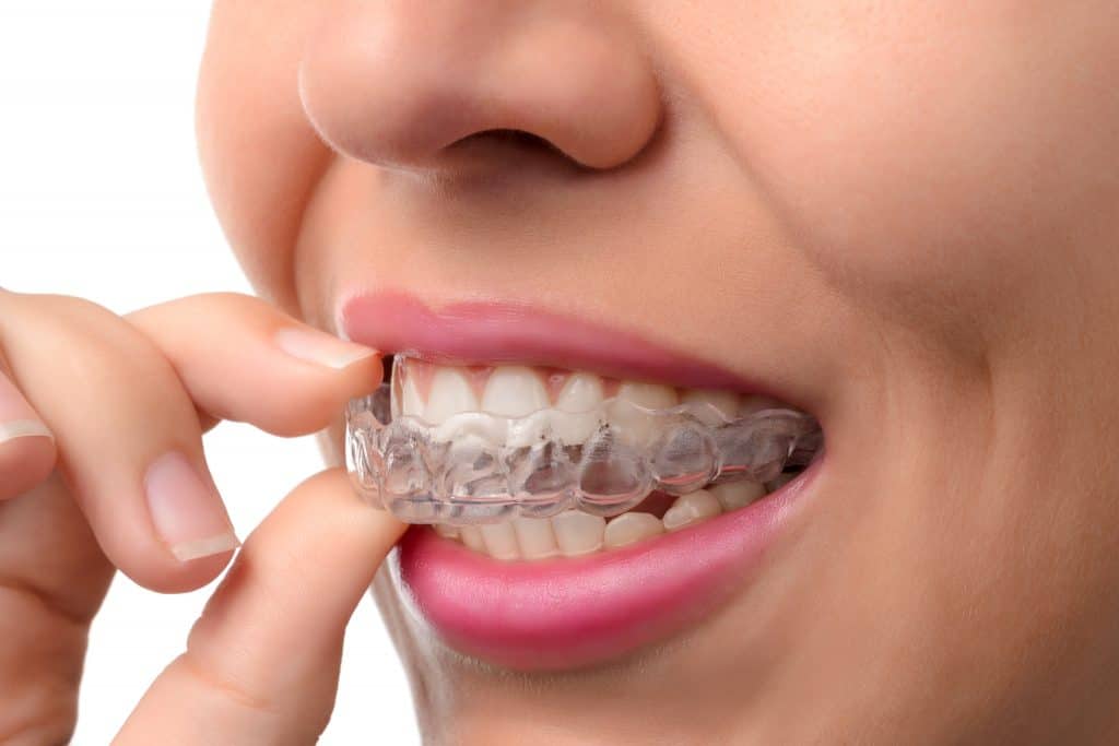 The Ultimate Guide to Invisalign: Cost and Benefits