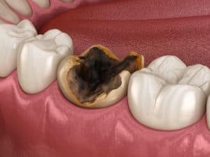 Discoloured or dead tooth image