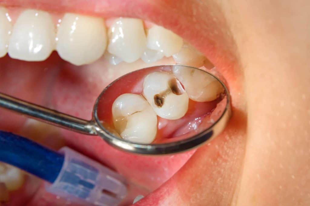 Dental checkup for Cavity