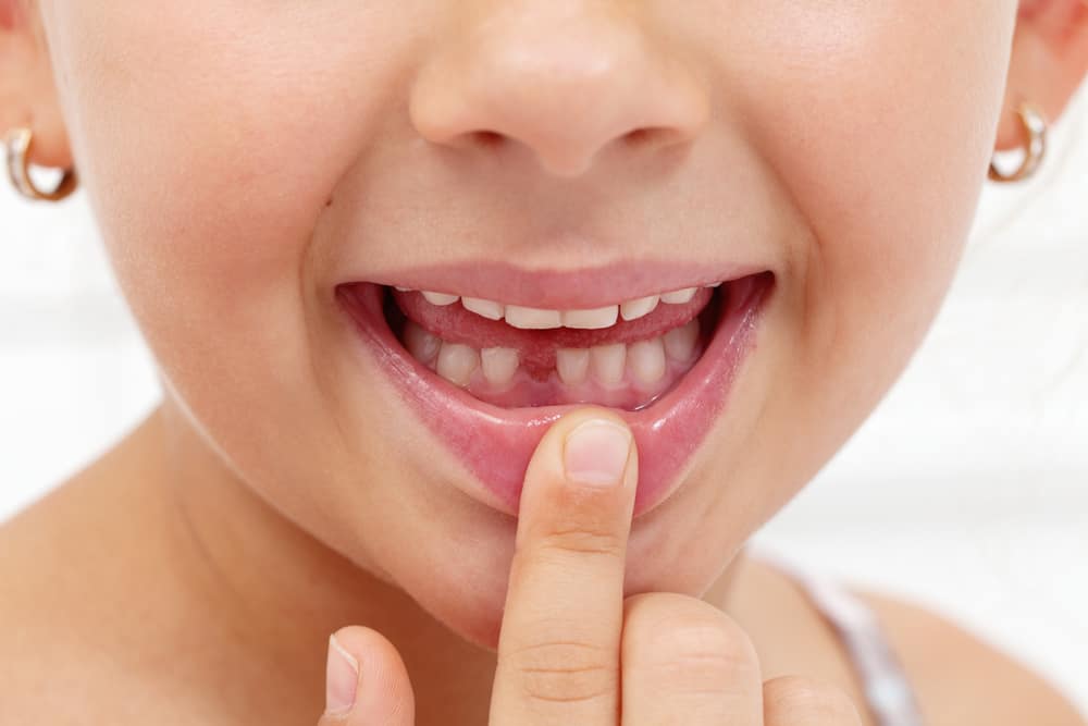 Kids Common Dental Problems