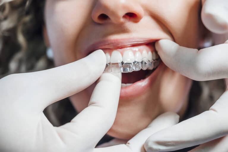 How to Properly Clean Your Invisalign?